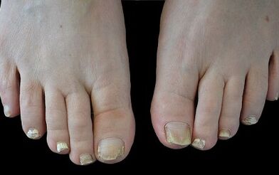 How to remove mushrooms on your fingers