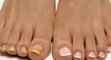 Fleet mushroom treatment