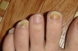 Yellow nails due to fungus