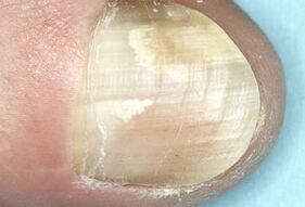 nail plate damage due to fungal infection