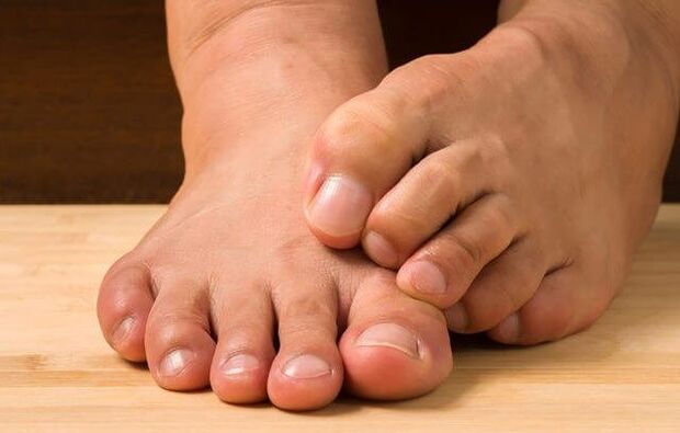 Foot fungus and how to treat it