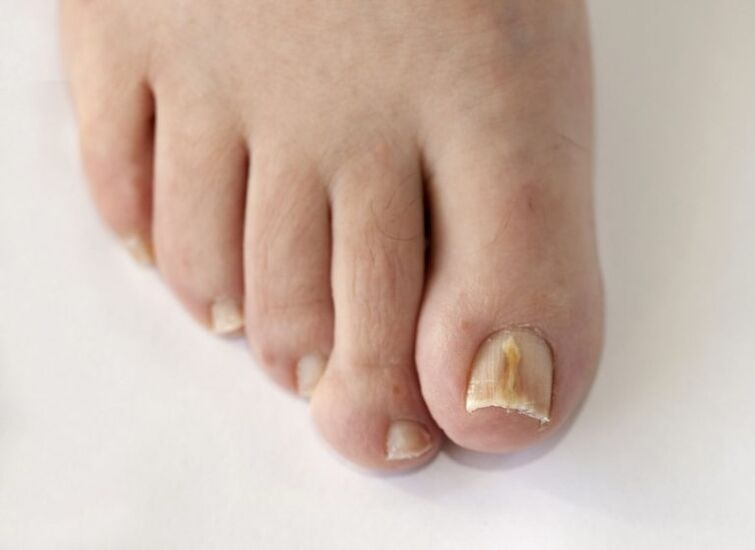 Toenail plates are affected by fungus