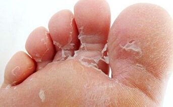 How to cure foot fungus