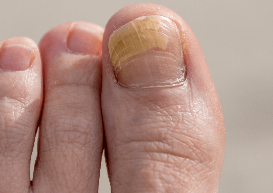 fungus on the big toenail