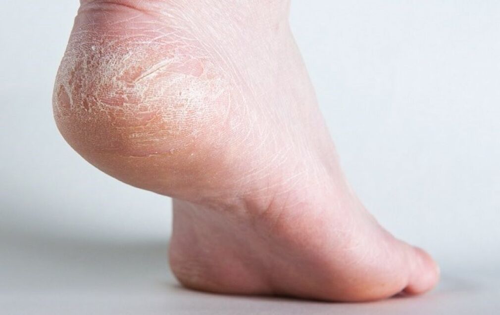 athlete's foot