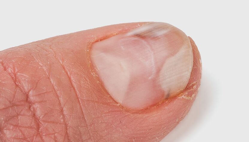 Dystrophic nail fungus